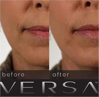 Lip Filler Revanesse Versa 1.2 cc