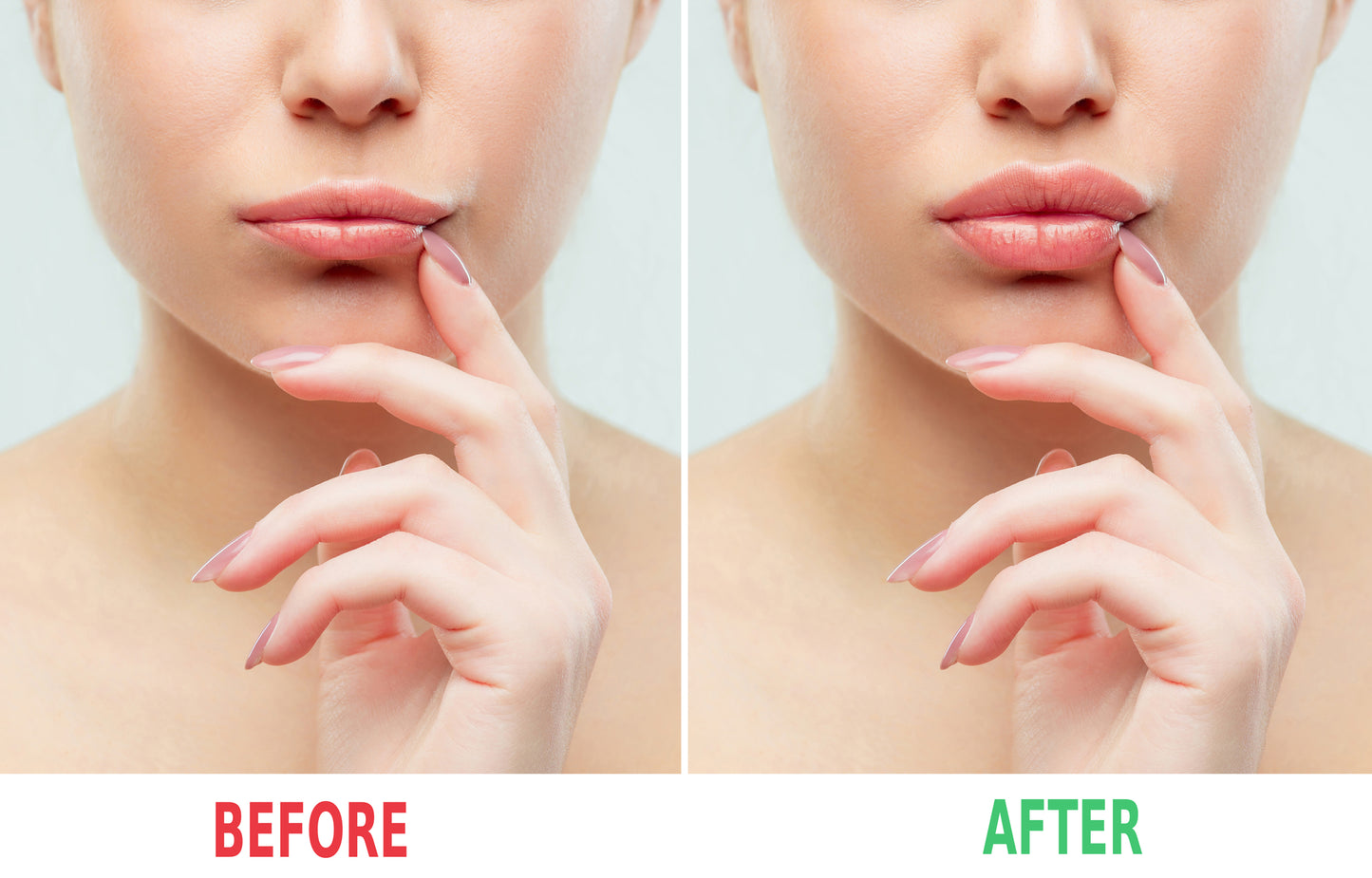 Lip Filler Restylane Kysse