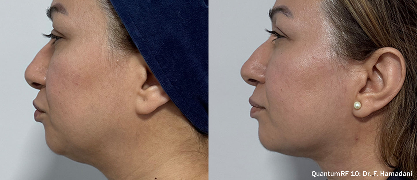Quantum RF Skin Tightening- Surgical results with no downtime