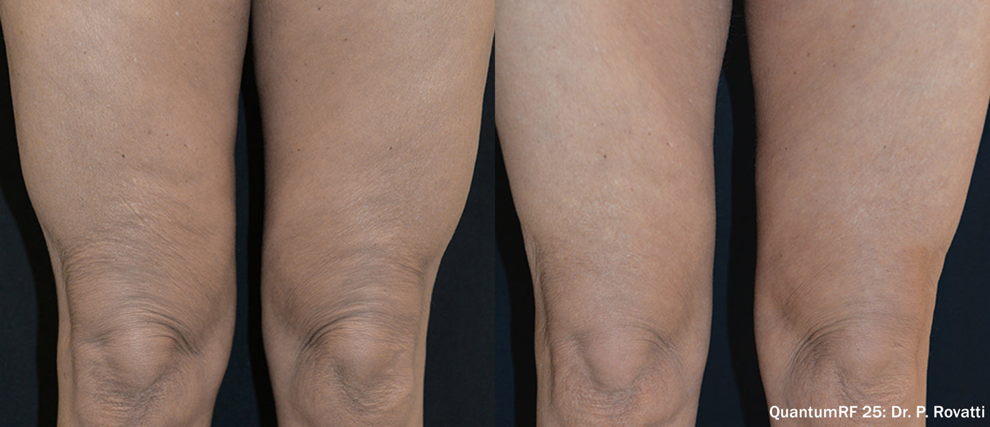 Quantum RF Skin Tightening- Surgical results with no downtime