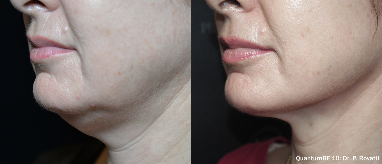 Quantum RF Skin Tightening- Surgical results with no downtime