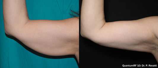 Morpheus 8 Body Package