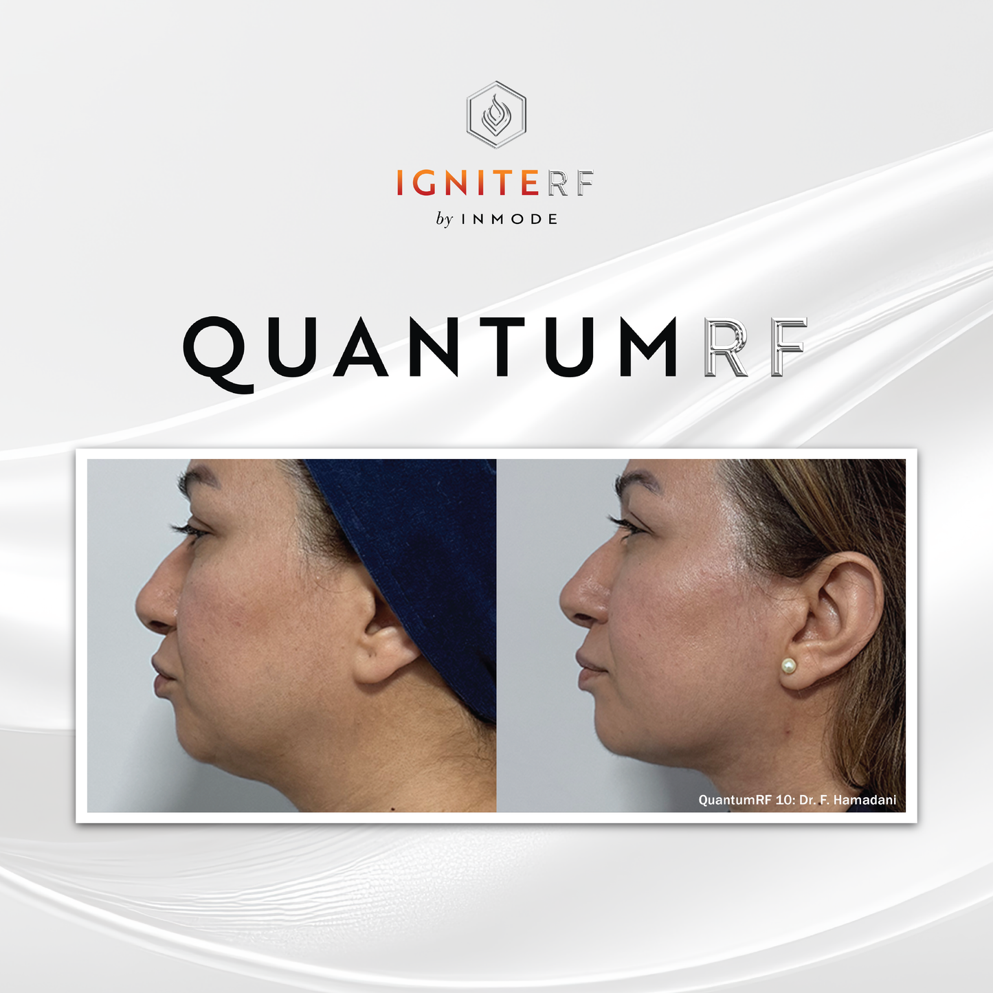 Quantum RF Skin Tightening- Surgical results with no downtime