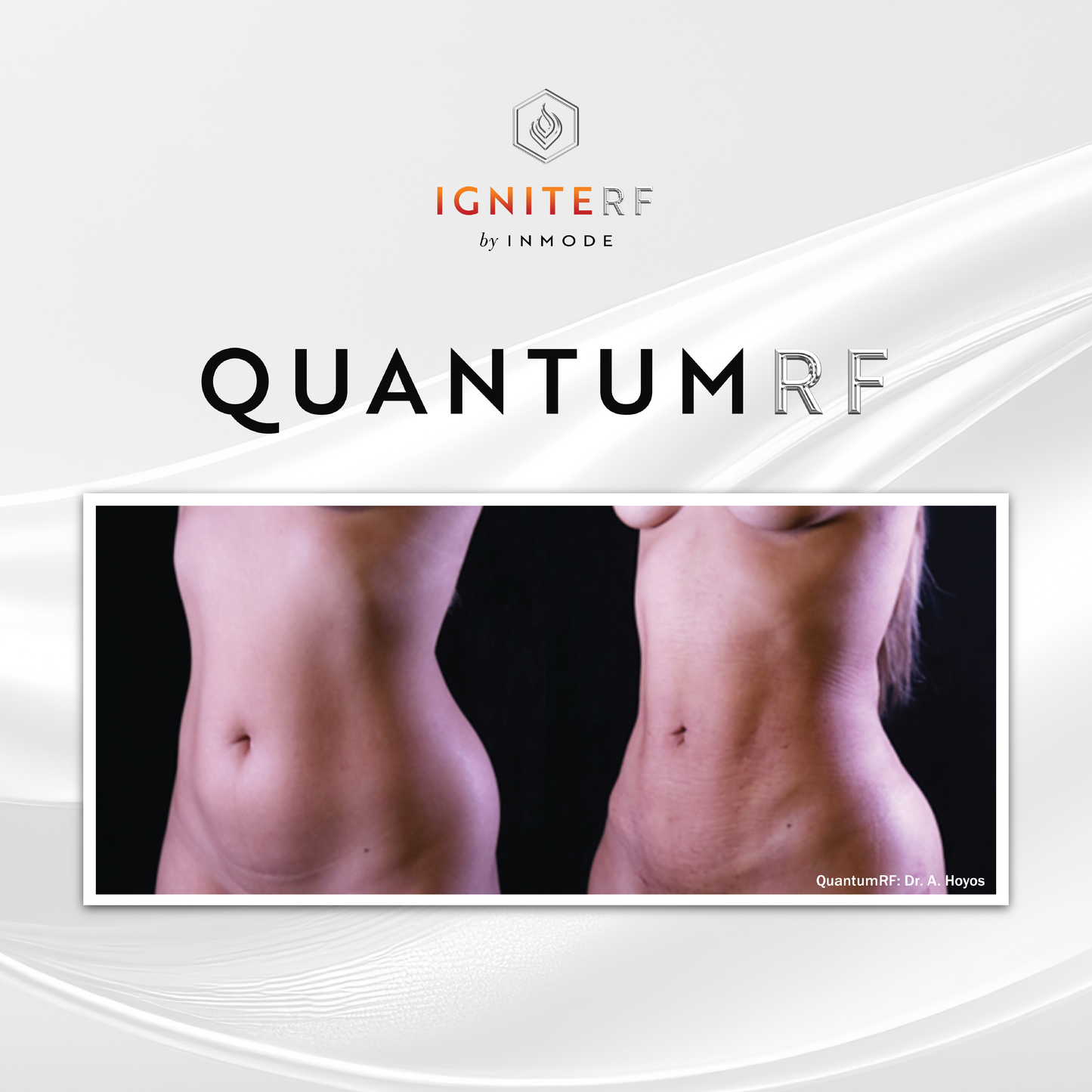 Quantum RF Skin Tightening- Surgical results with no downtime