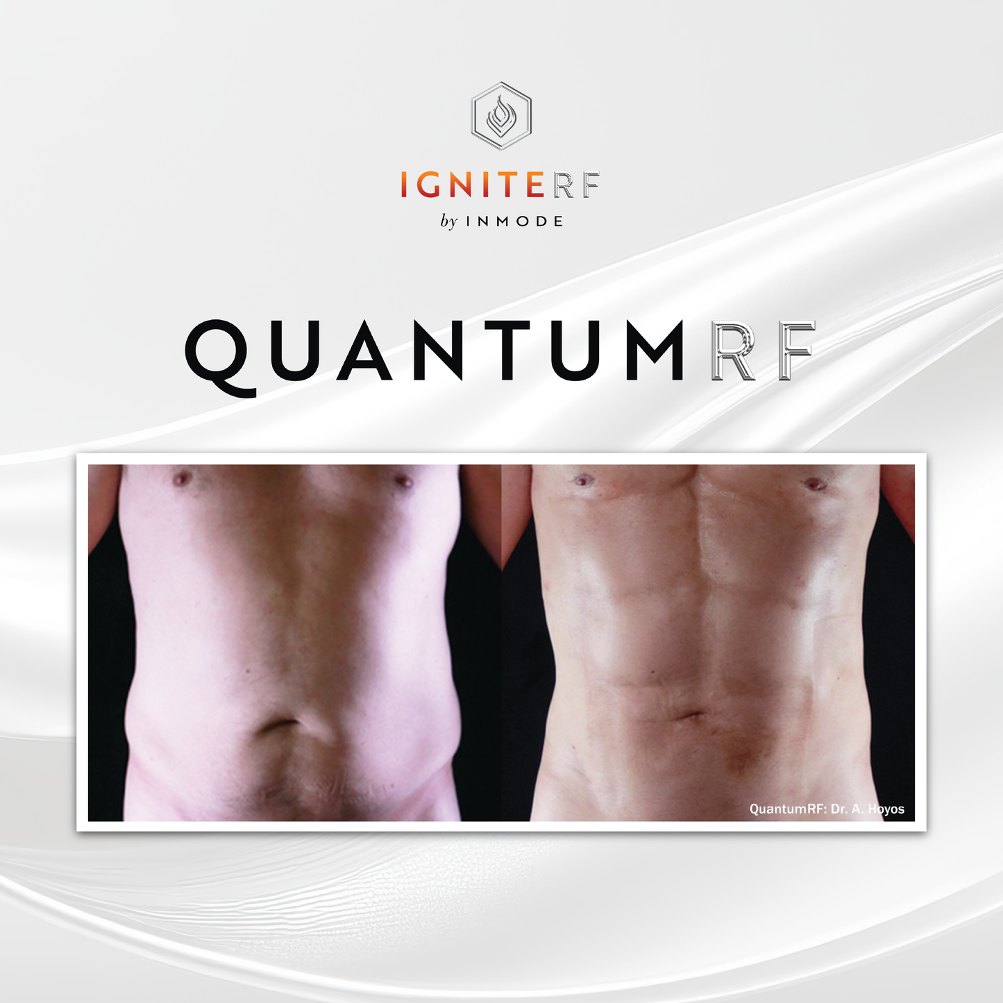 Quantum RF Skin Tightening- Surgical results with no downtime