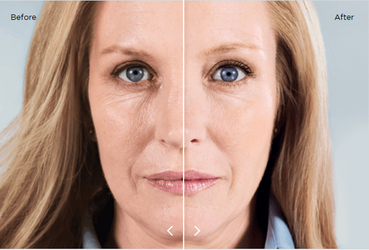 Sculptra PLLA Injectable Vial- Stimulate, Sculpt, and Smooth — Naturally Over Time