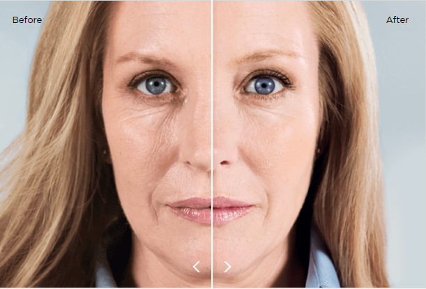 Sculptra PLLA Injectable Vial- Stimulate, Sculpt, and Smooth — Naturally Over Time