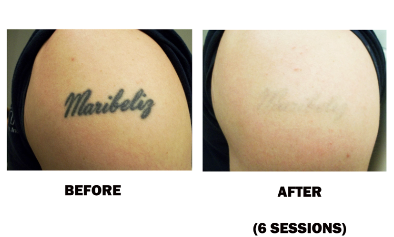 Tattoo Removal Package Pre-sale ( 6 sessions)