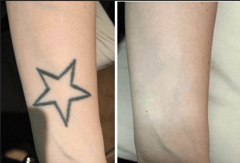 Tattoo Removal Package Pre-sale ( 6 sessions)