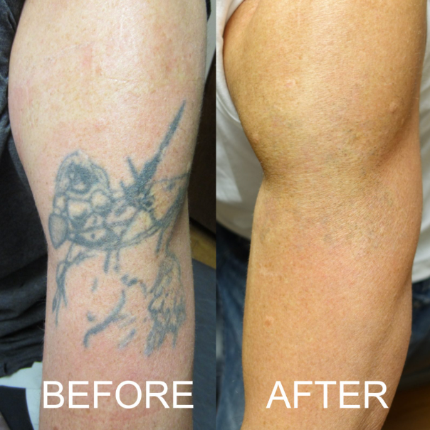 Tattoo Removal Package Pre-sale ( 6 sessions)