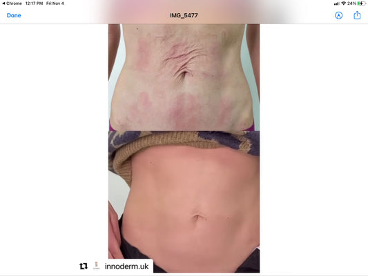 Morpheus 8 Body Package