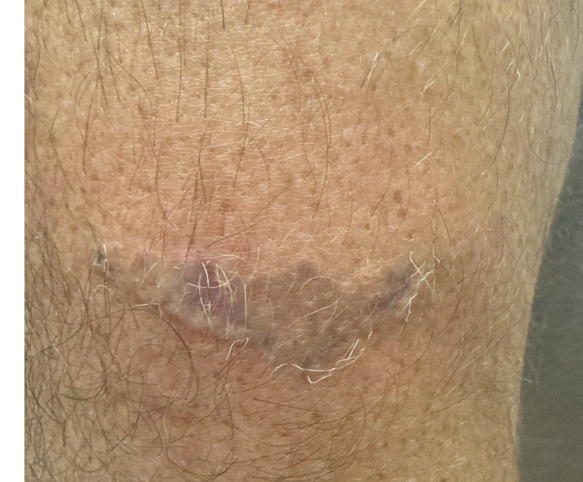 Laser tattoo removal fading after 3-4 TORO treatments at Reflections