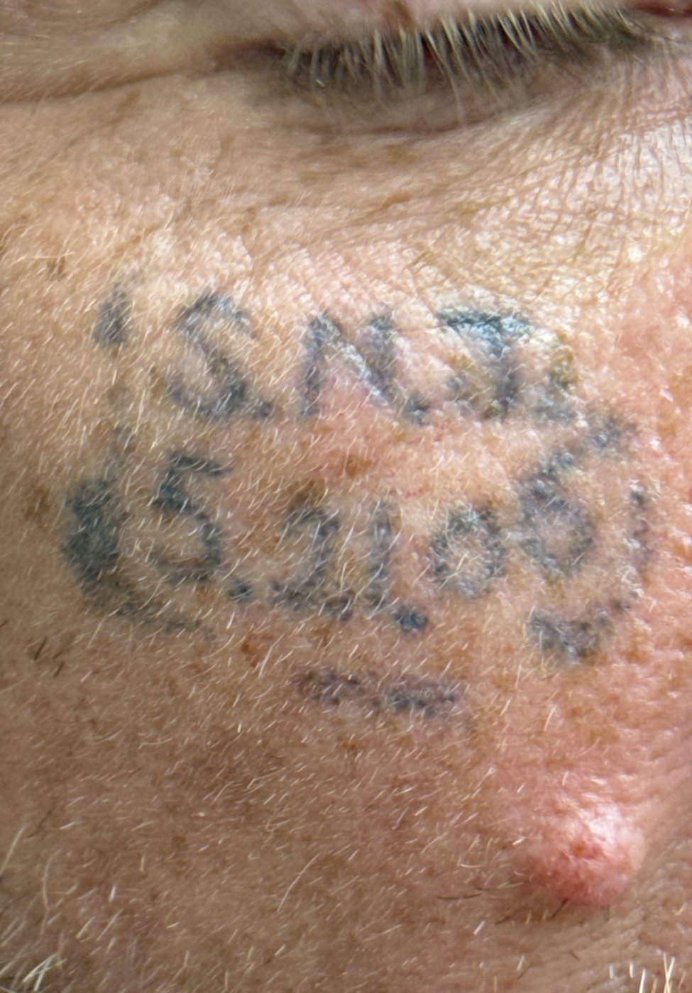 Laser tattoo removal fading after 3-4 TORO treatments at Reflections