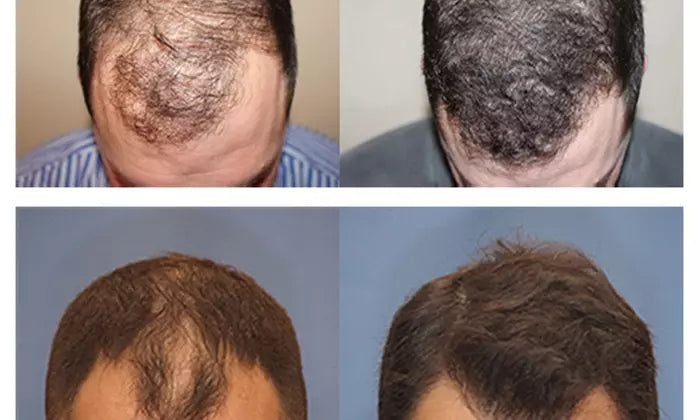 Hair Restoration with PRP and Nutrafol Supplementation