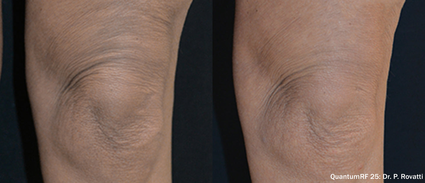 Morpheus 8 Body Single Session