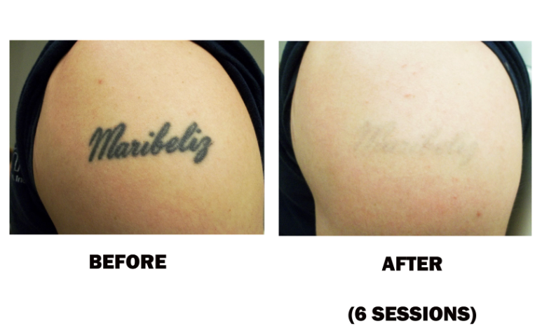 Tattoo Removal Package  Pre-sale ( 6 sessions)