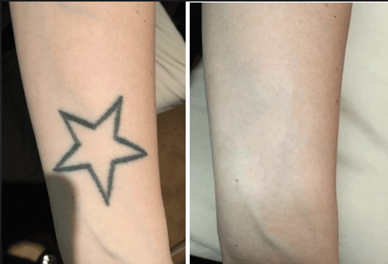 Tattoo Removal Package  Pre-sale ( 6 sessions)