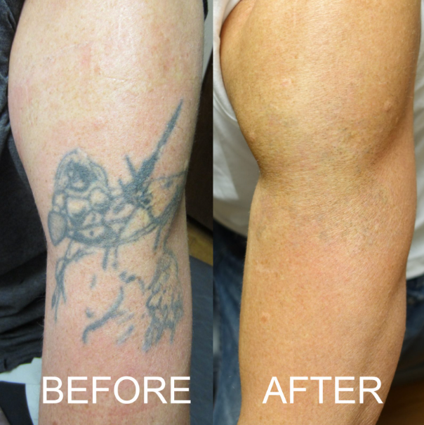 Tattoo Removal Package  Pre-sale ( 6 sessions)