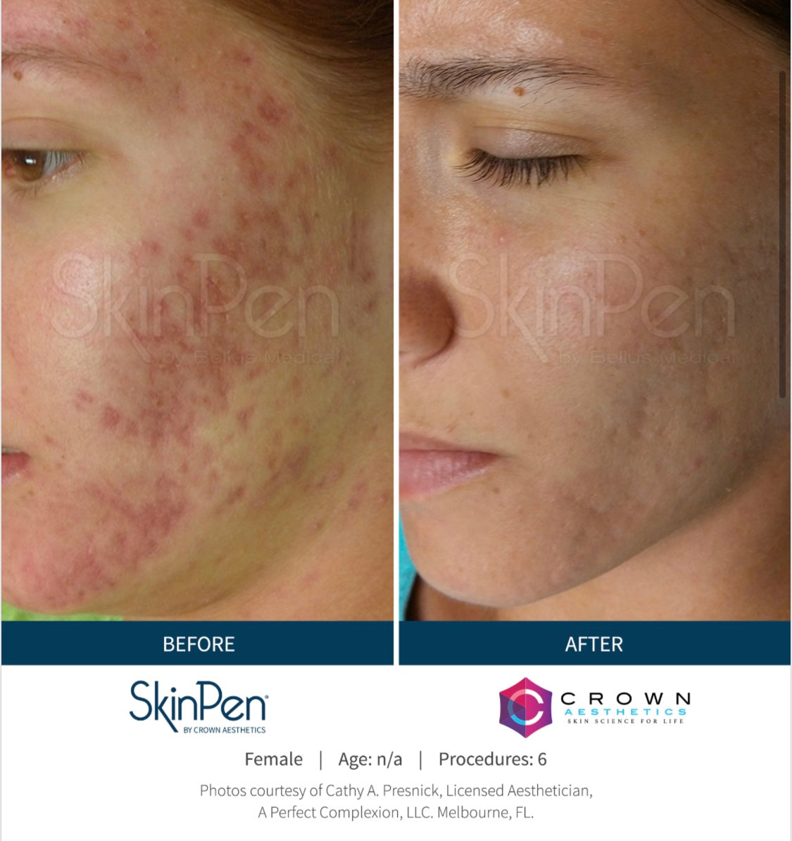 SkinPen Microneedling Session