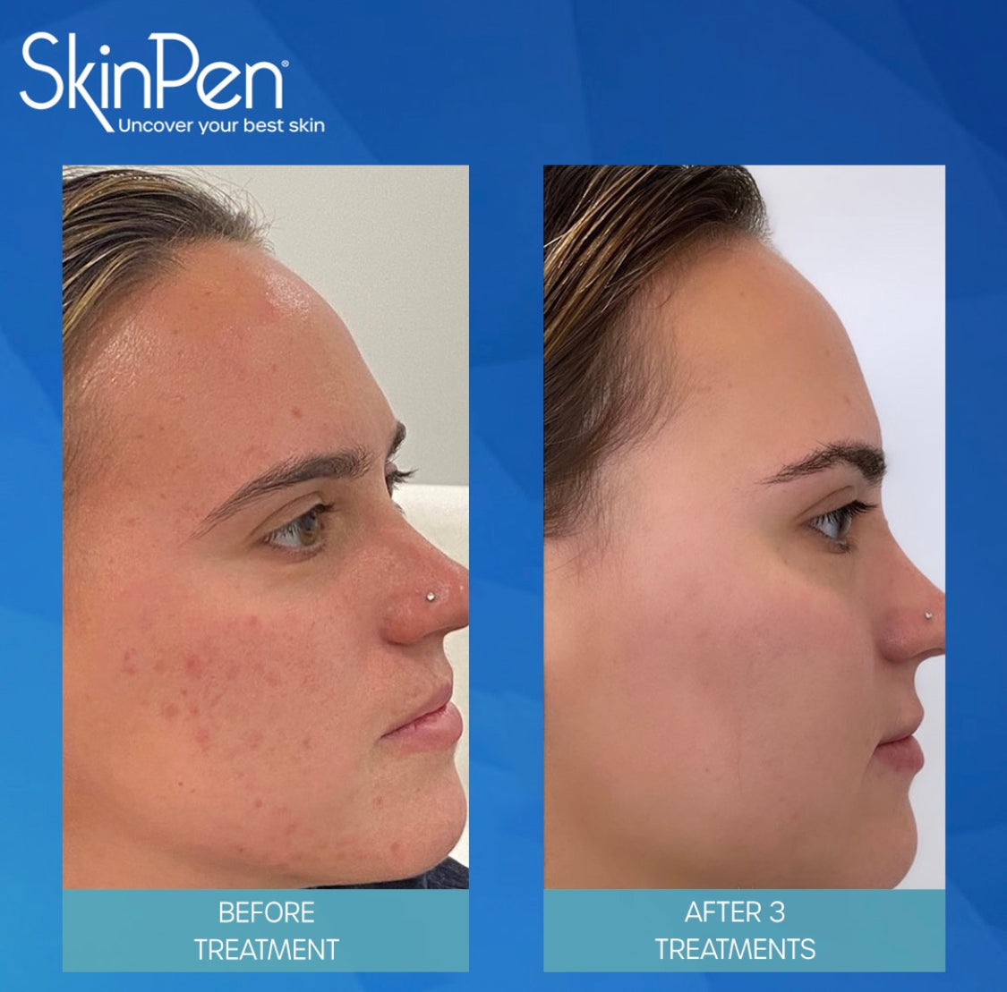 SkinPen Microneedling Session