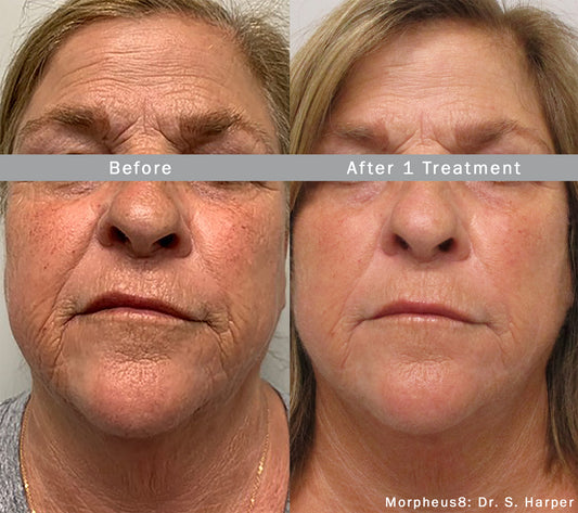 Morpheus 8 RF Microneedling Package