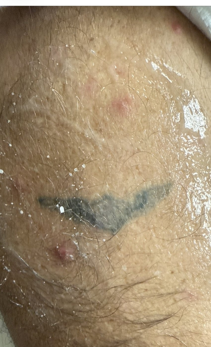Laser tattoo removal fading after 3-4 TORO treatments at Reflections