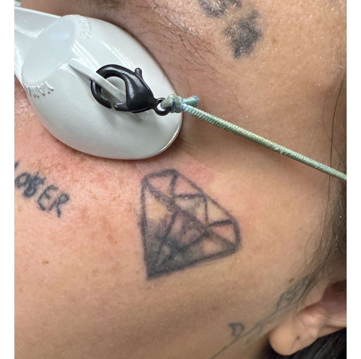 Laser tattoo removal fading after 3-4 TORO treatments at Reflections