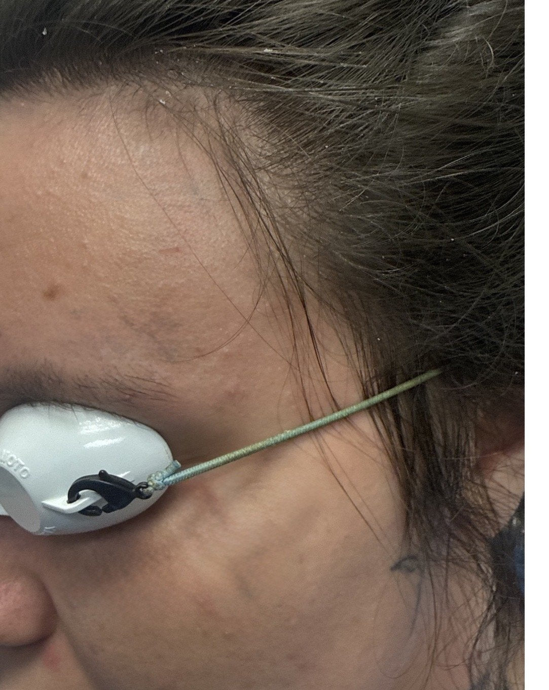 Laser tattoo removal fading after 3-4 TORO treatments at Reflections