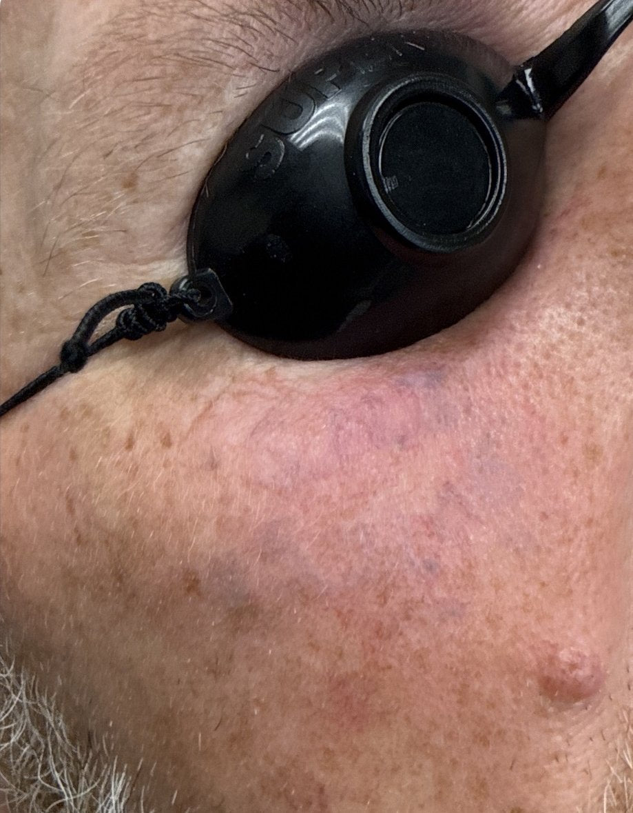 Laser tattoo removal fading after 3-4 TORO treatments at Reflections
